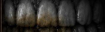 Close-up macro photograph of teeth with sugary residue.
