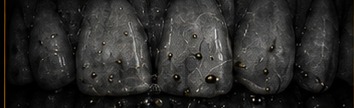 Macro photograph of tooth surfaces under acidic conditions.